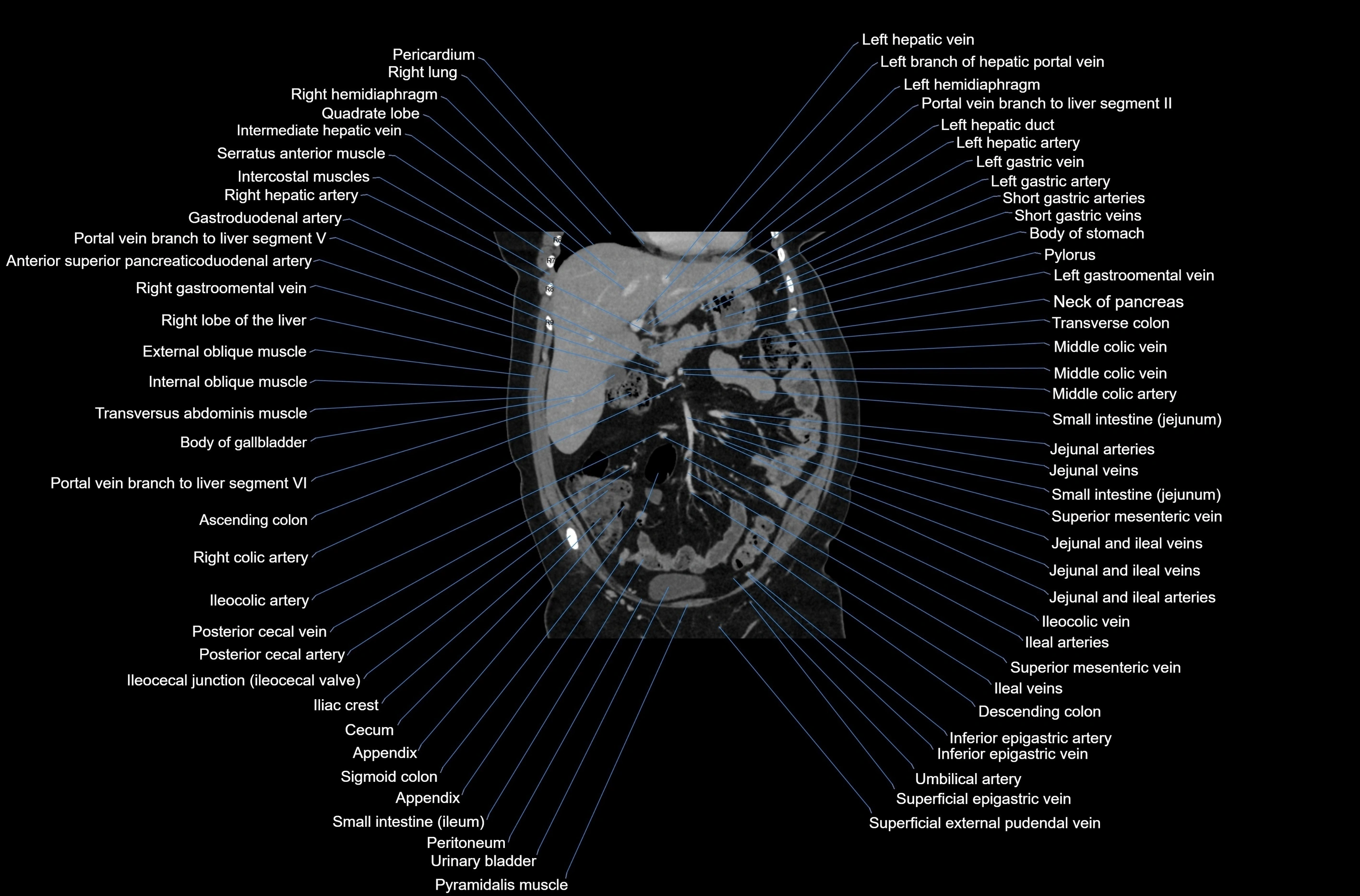 CT abdomen coronal cross sectional anatomy labelled radiology image-00031.webp